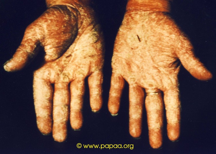 Psoriasis on palms of hands.jpg