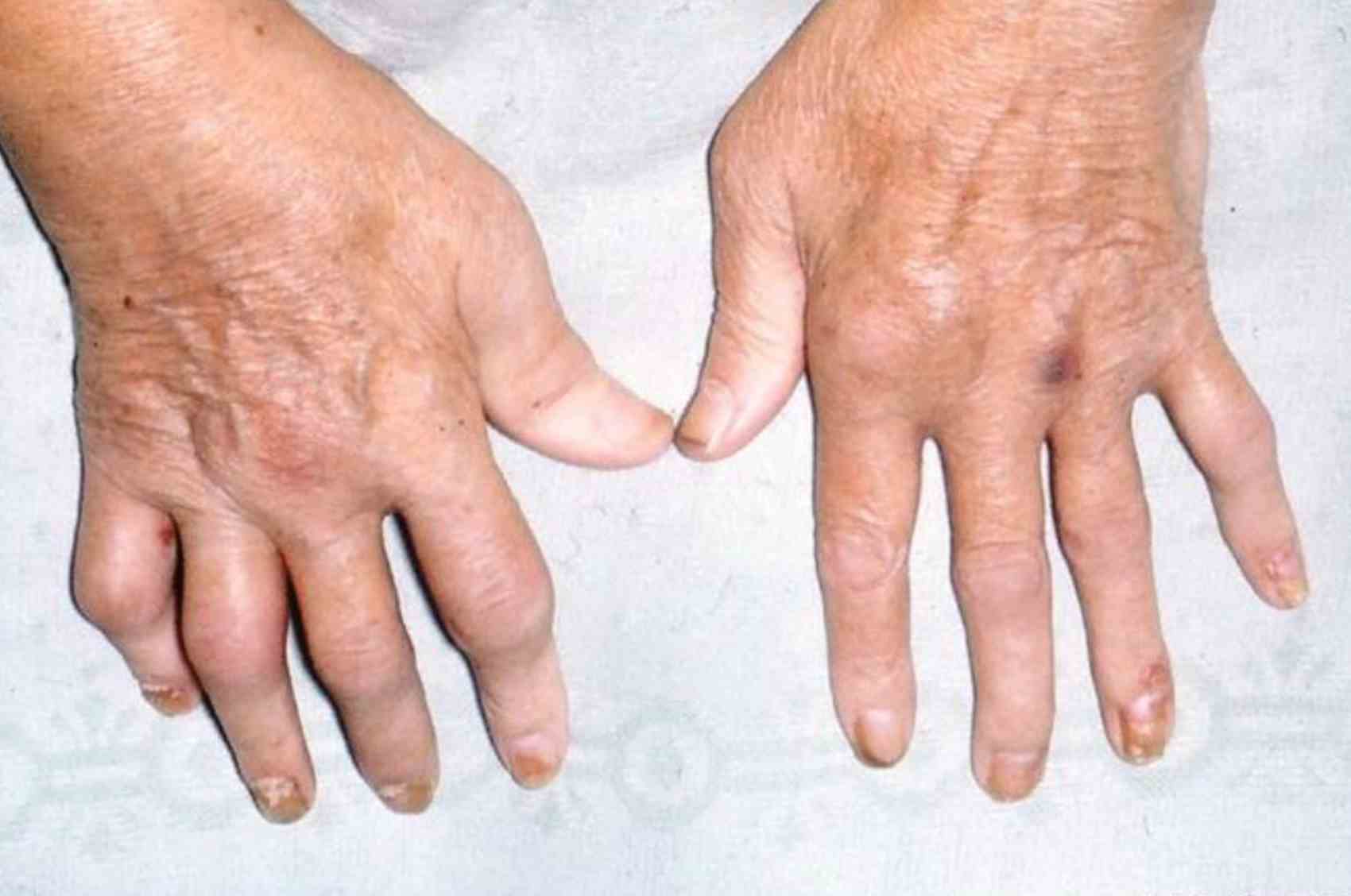 Artritis psoriasica manos