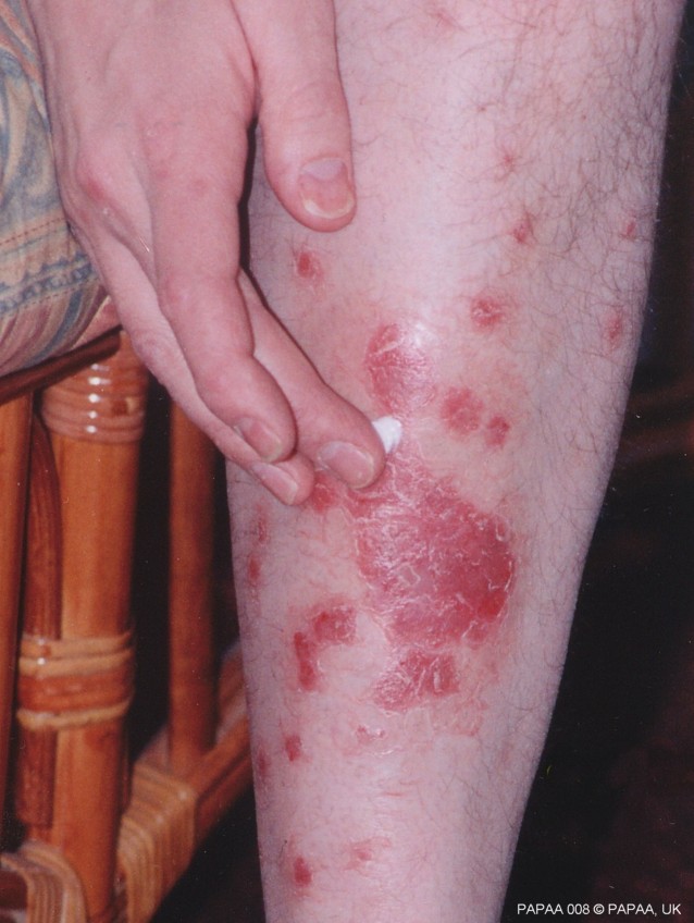 Treating psoriasis.jpg