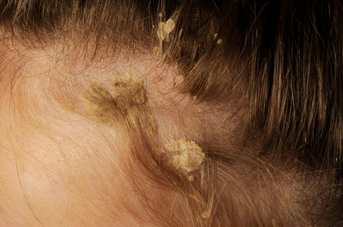 Treating psoriasis on the scalp, hairline, forehead, behind the ears and  back of the neck