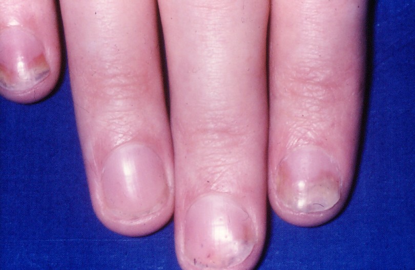 Psoriasis in the fingernails and toenails