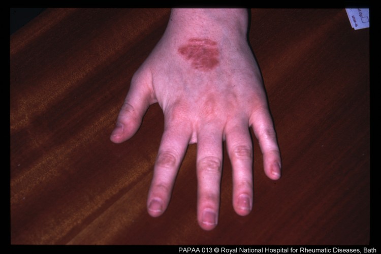Psoriatic Arthritis Is An Inflammatory Joint Condition Associated With