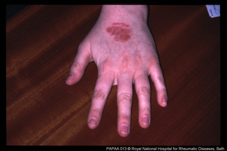 Psoriatic arthritis is an inflammatory joint condition associated with