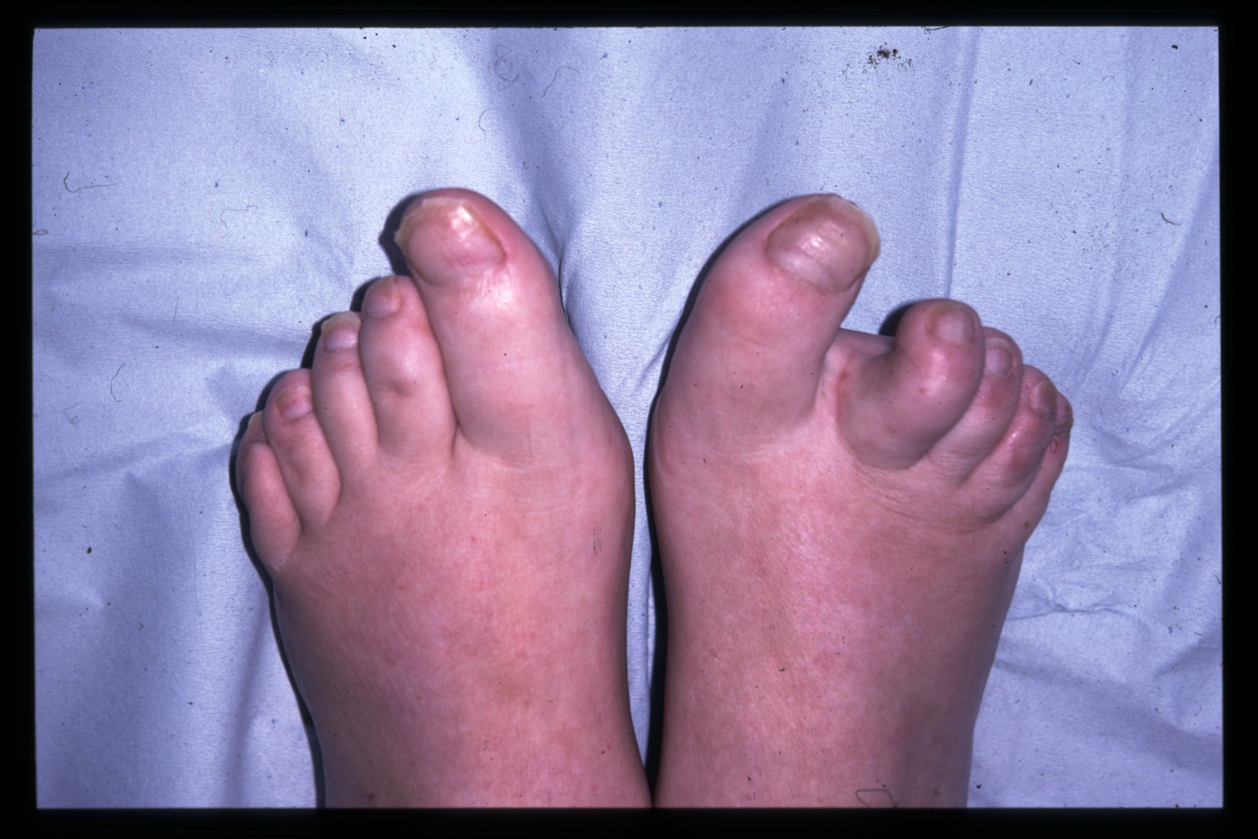 The Hard Facts About Foot Calluses  DermMedica