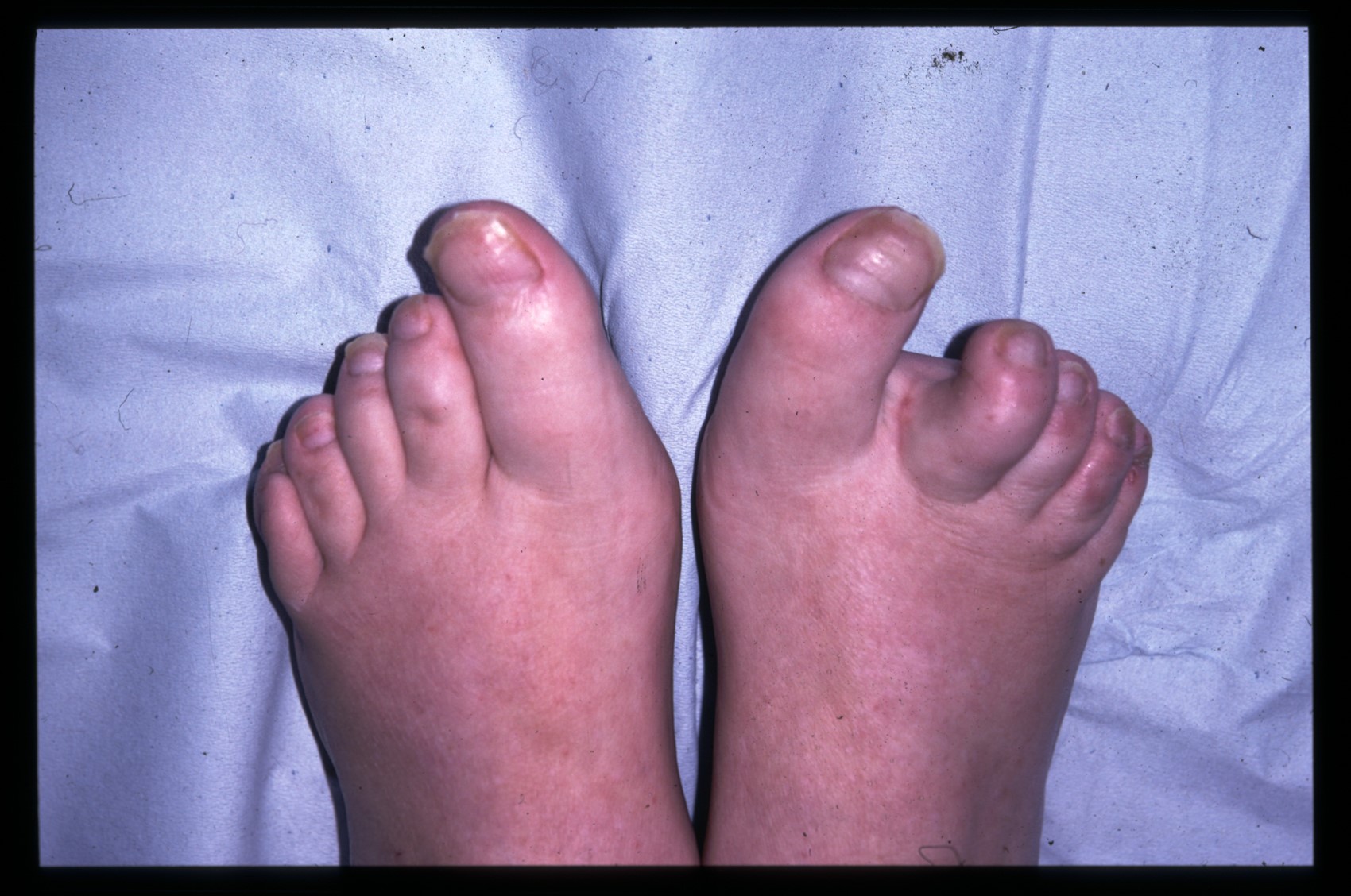 psoriasis on toes kezelés)