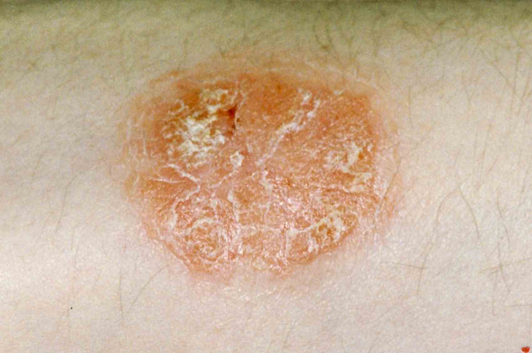 Types of psoriasis, who gets it, how they are affected and what to expect.