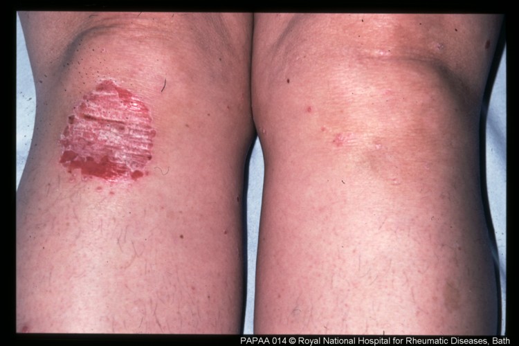 Psoriatic arthritis knees.jpg