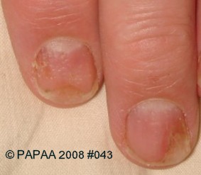 Nail psoriasis 2.jpg