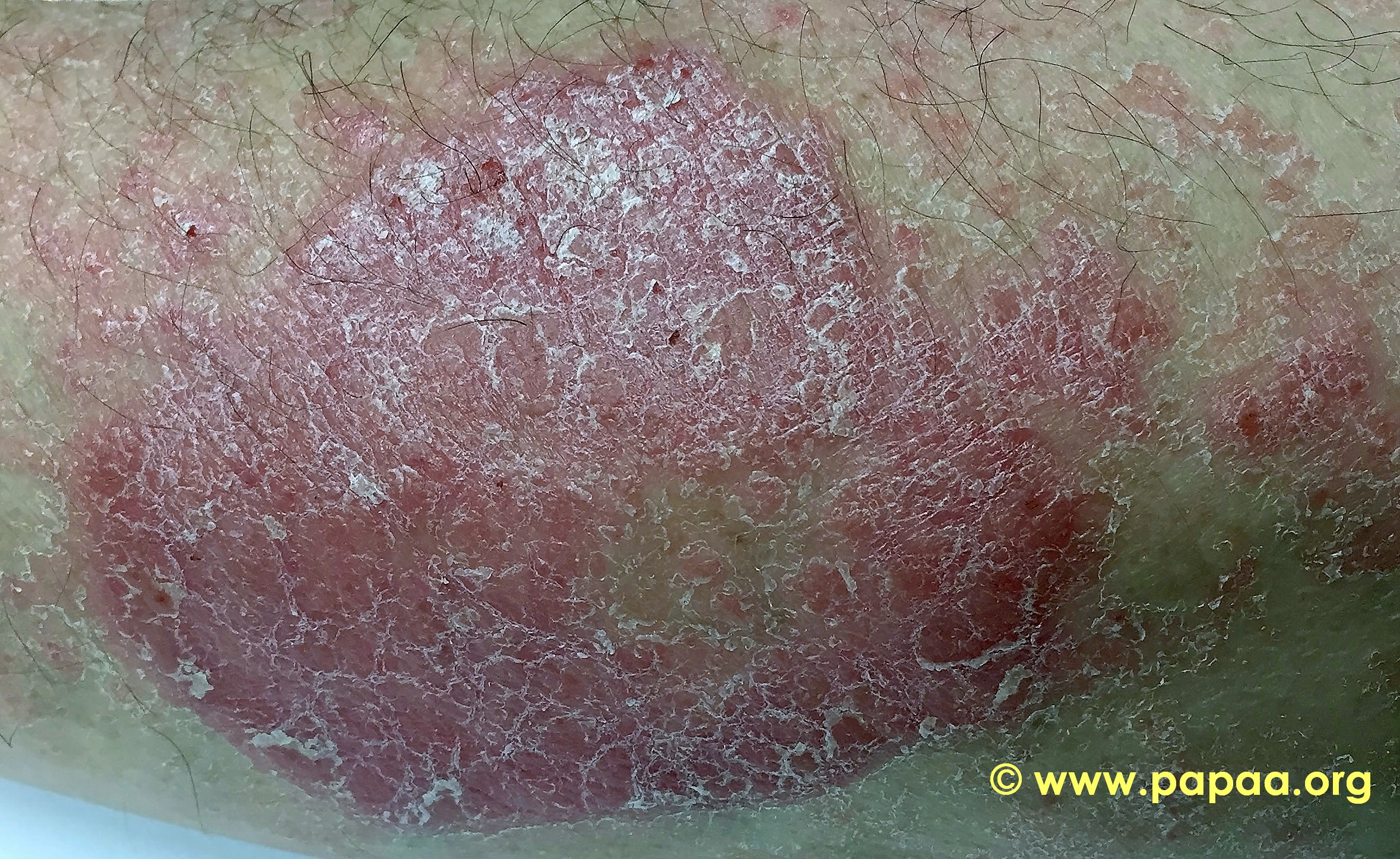 Close Up Large Red Raised Scaly Plaque Psoriasisjpg