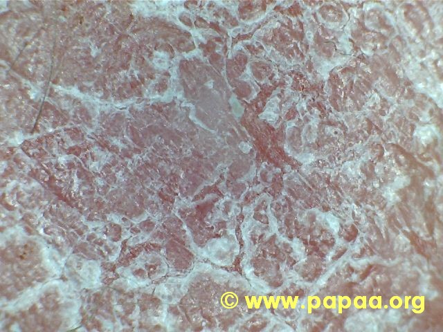 Close Up Scaly Psoriasis Plaque