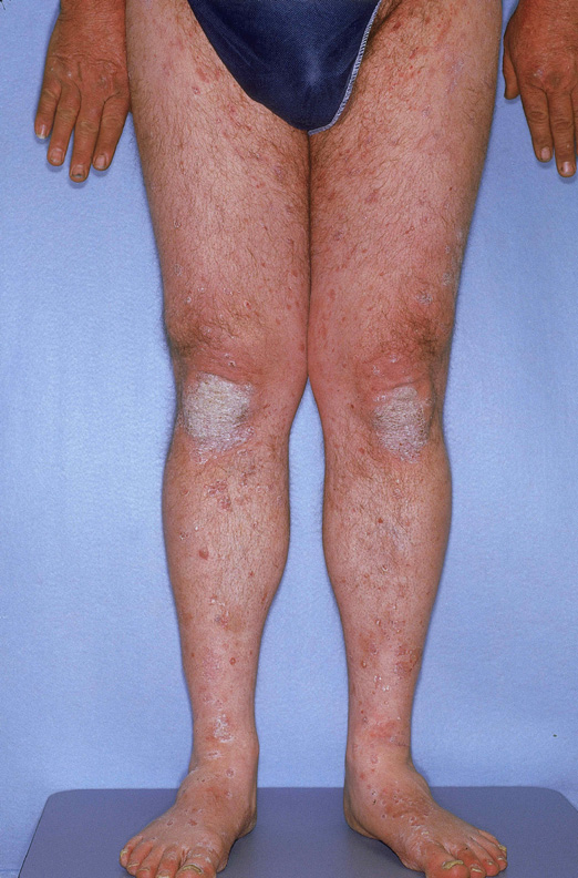 Psoriaisis On Front Of Legs 2