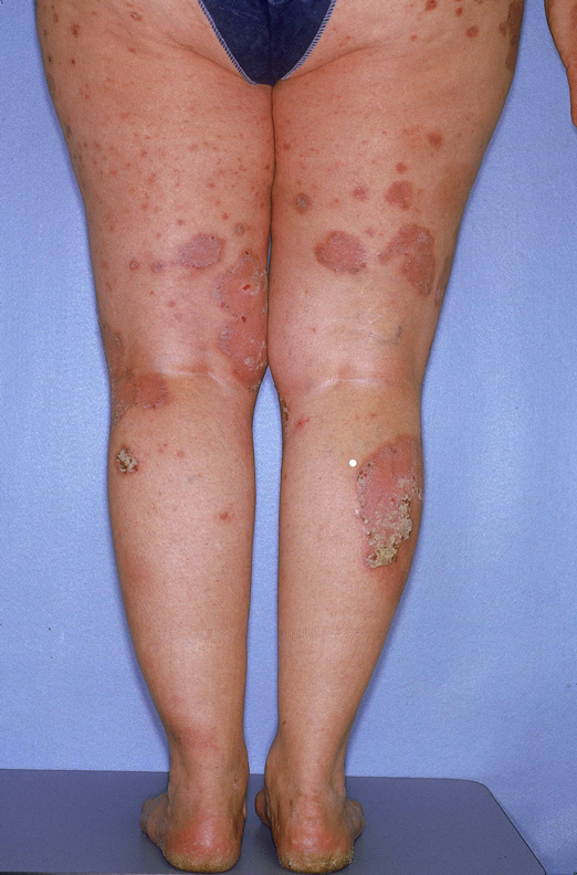 Psoriaisis On Legs 3