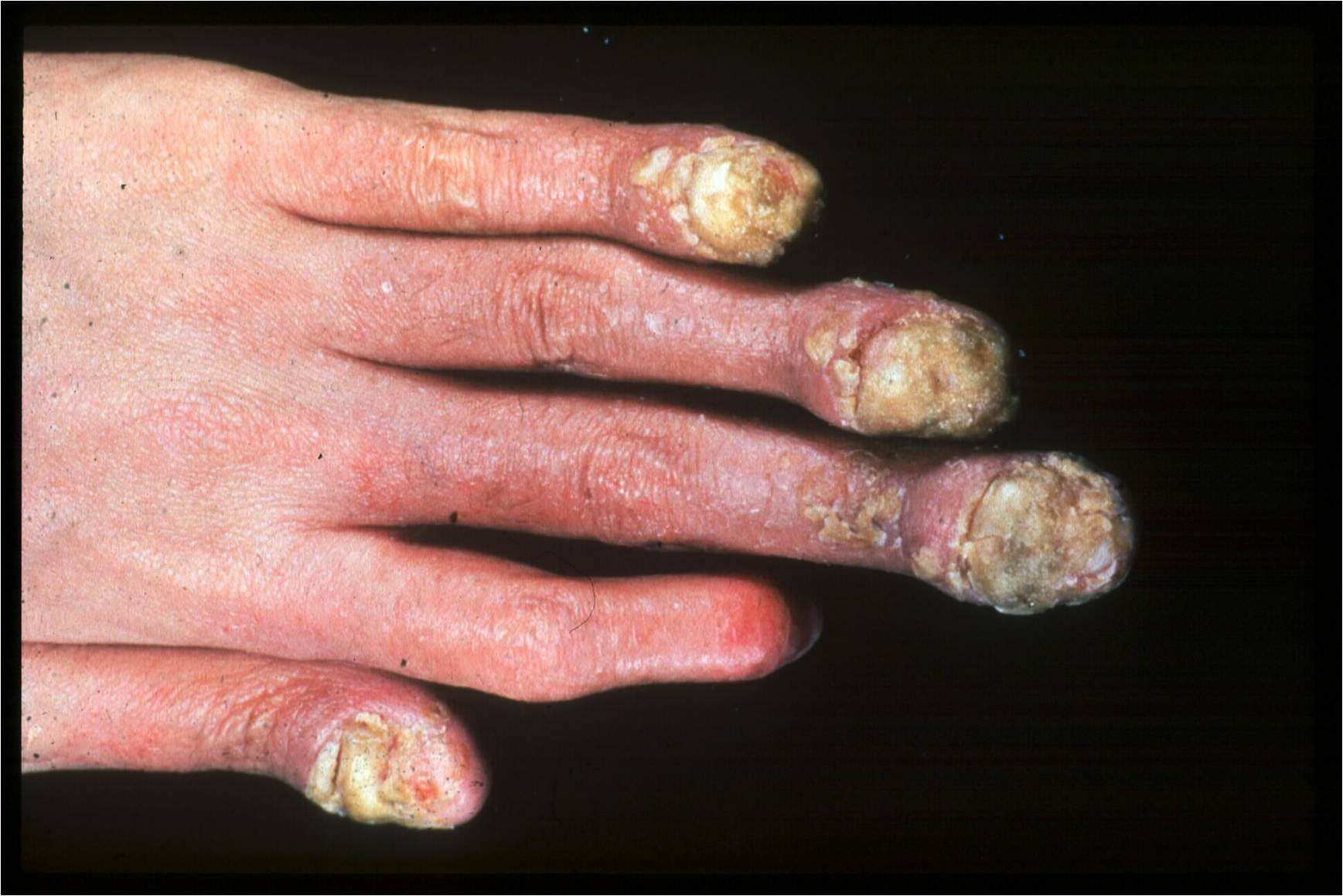 Psoriasis On Fingers
