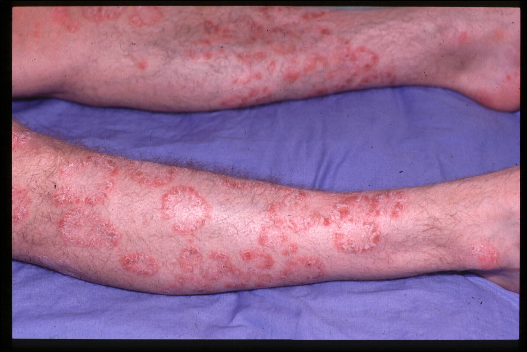 Psoriasis On Legs 1