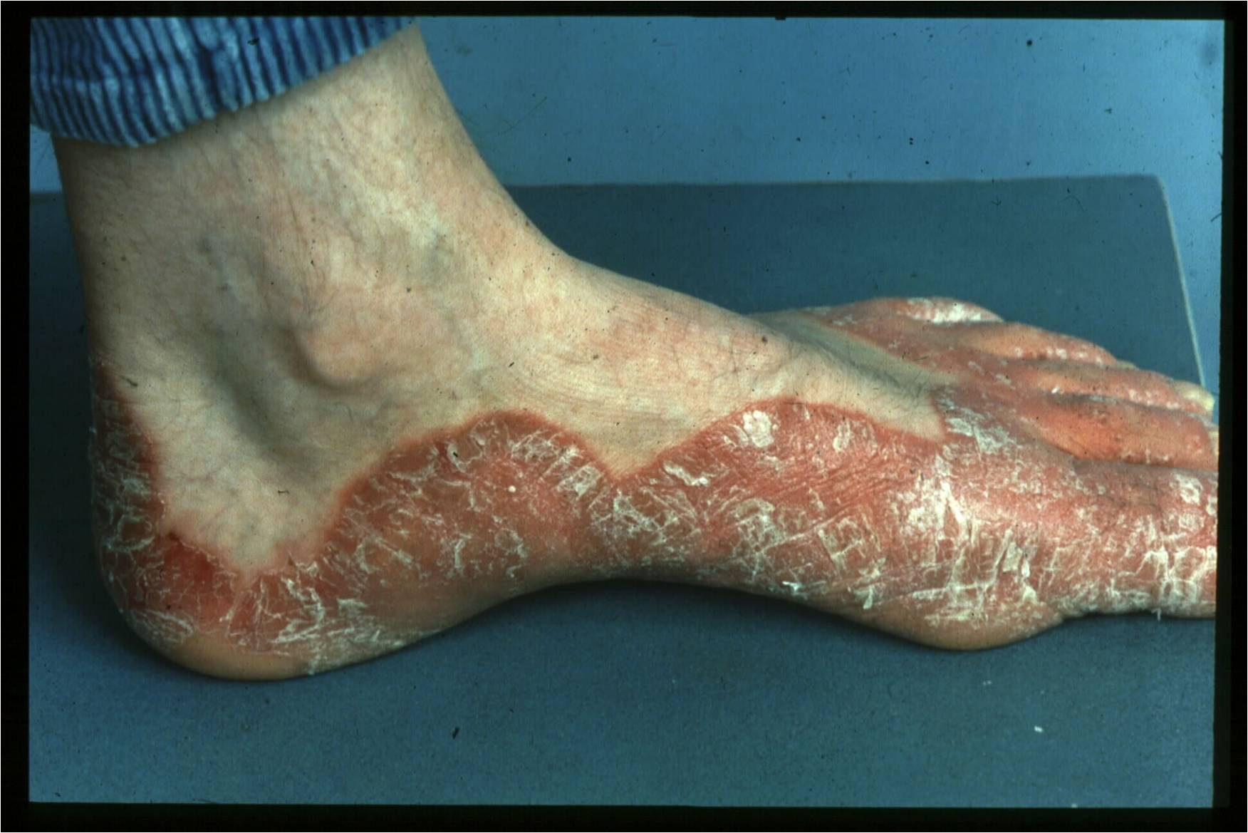 Psoriasis On Left foot