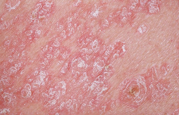 Psoriasis Close Up 2