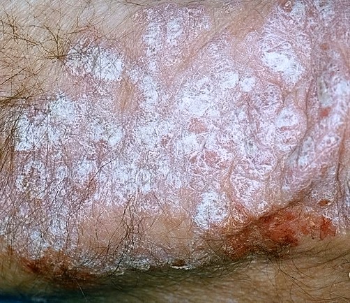 Psoriasis Close Up 4