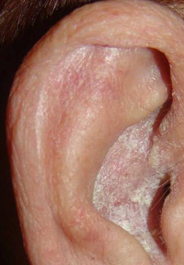 Psoriasis In The Ear