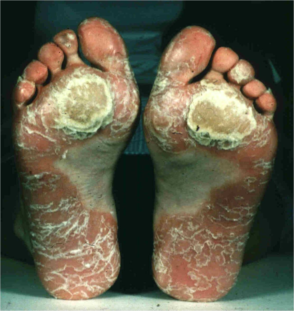 Psoriasis On Soles Of Feet