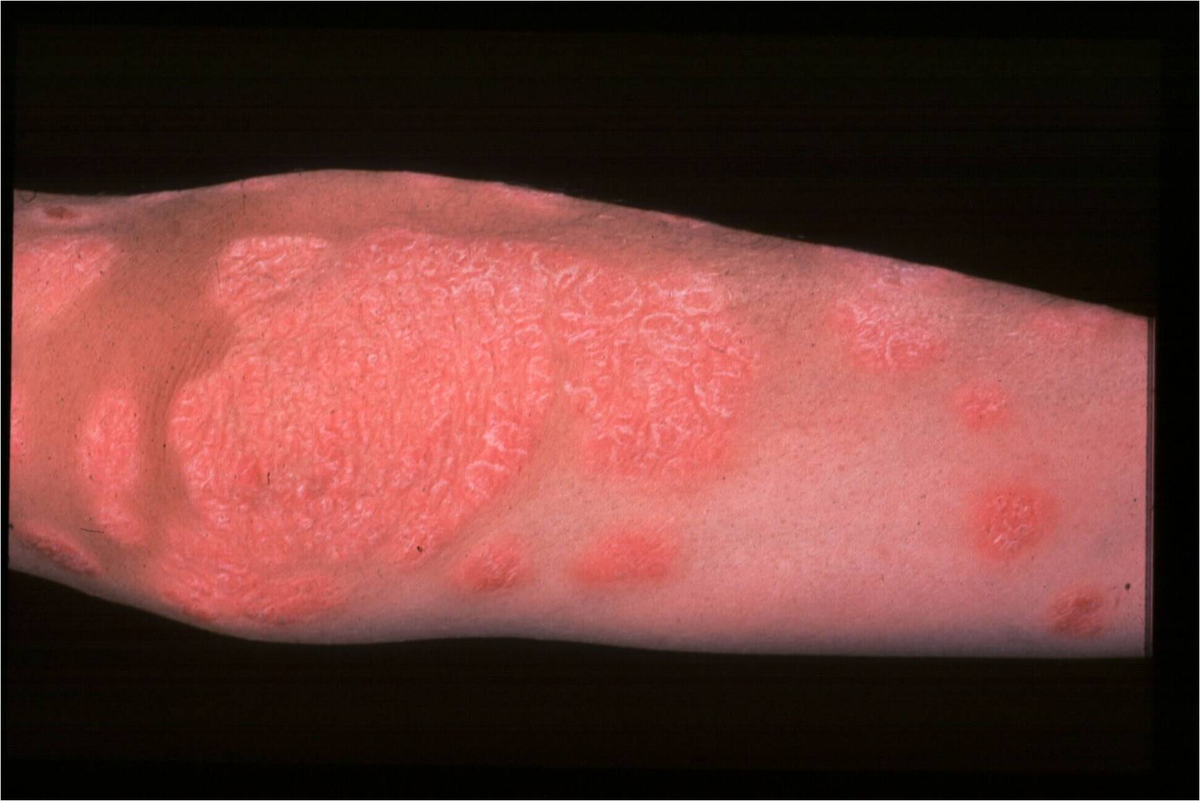 Psoriasis On Elbow 1