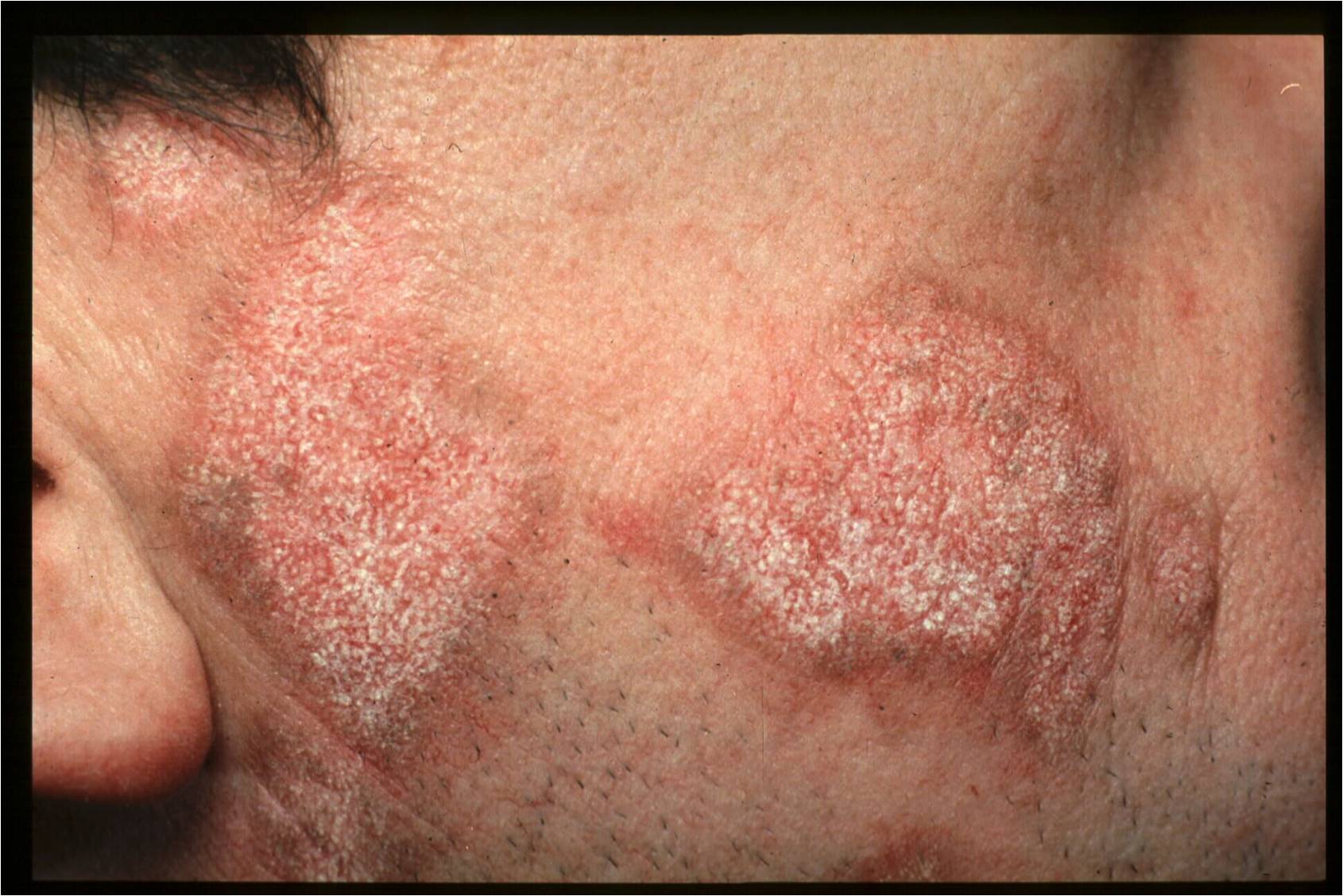 Discoid Lupus Erythematosis