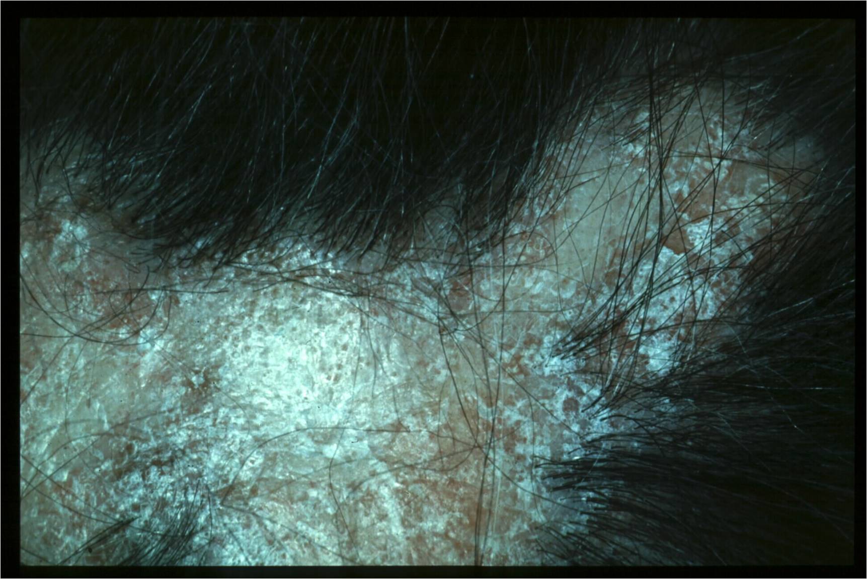 Discoid Lupus Erythematosus