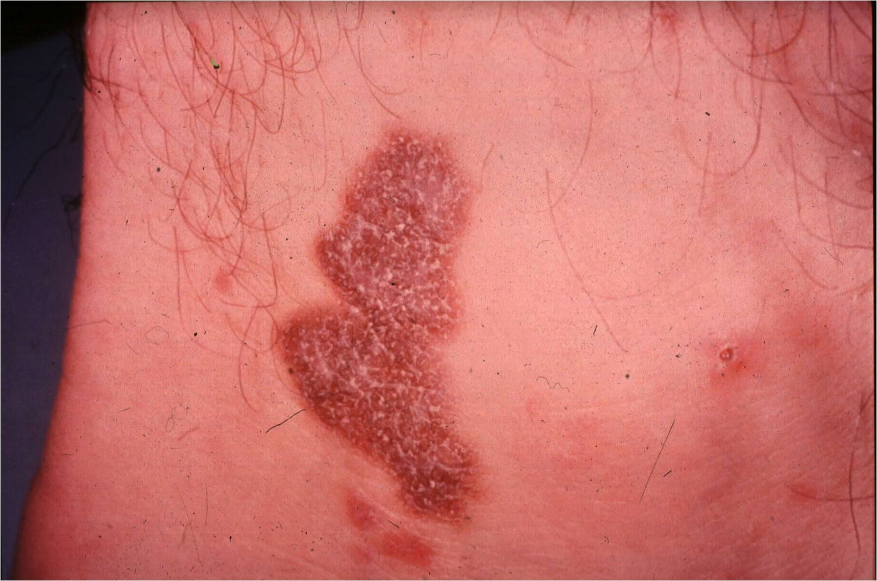Hypertrophic Lichen Planus