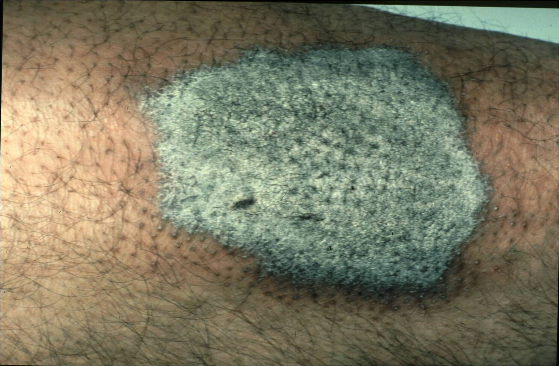 Lichen Simplex Chronicus