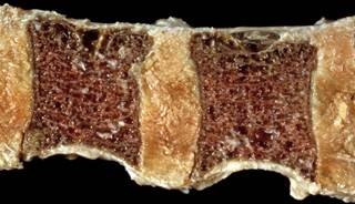 Osteoporosis