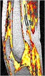 Rheumatoid Arthritis MRI Knees