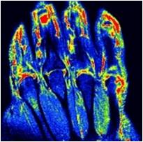 Rheumatoid Arthritis Within Joint Mri
