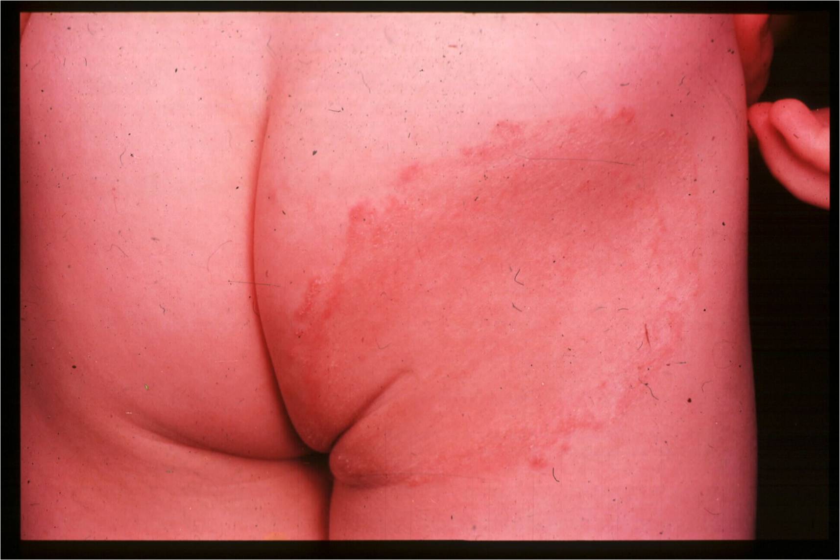 Ringworm