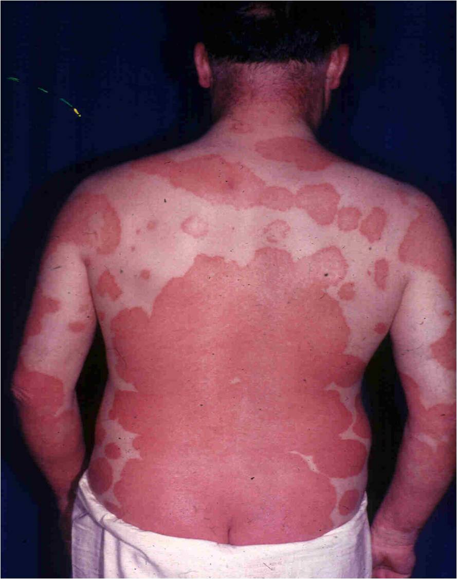 Erythrodermic Psoriasis 1
