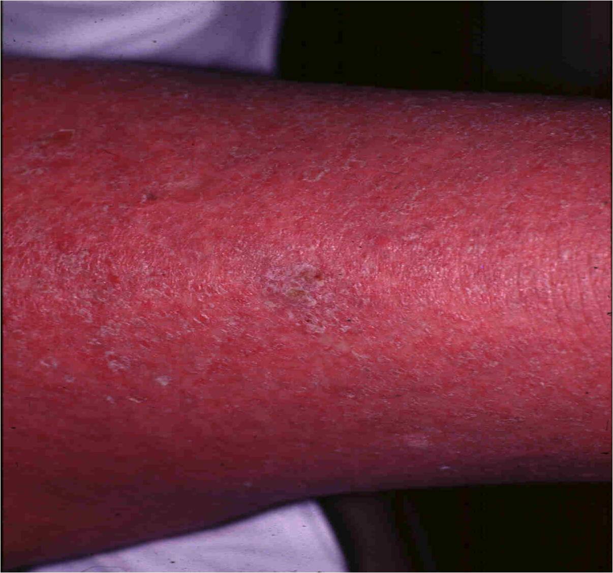 Erythrodermic Psoriasis