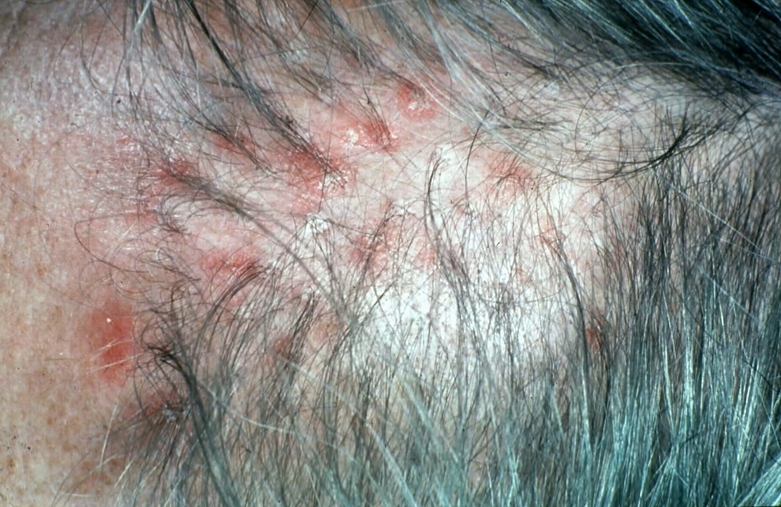 Scalp Psoriasis In Hair