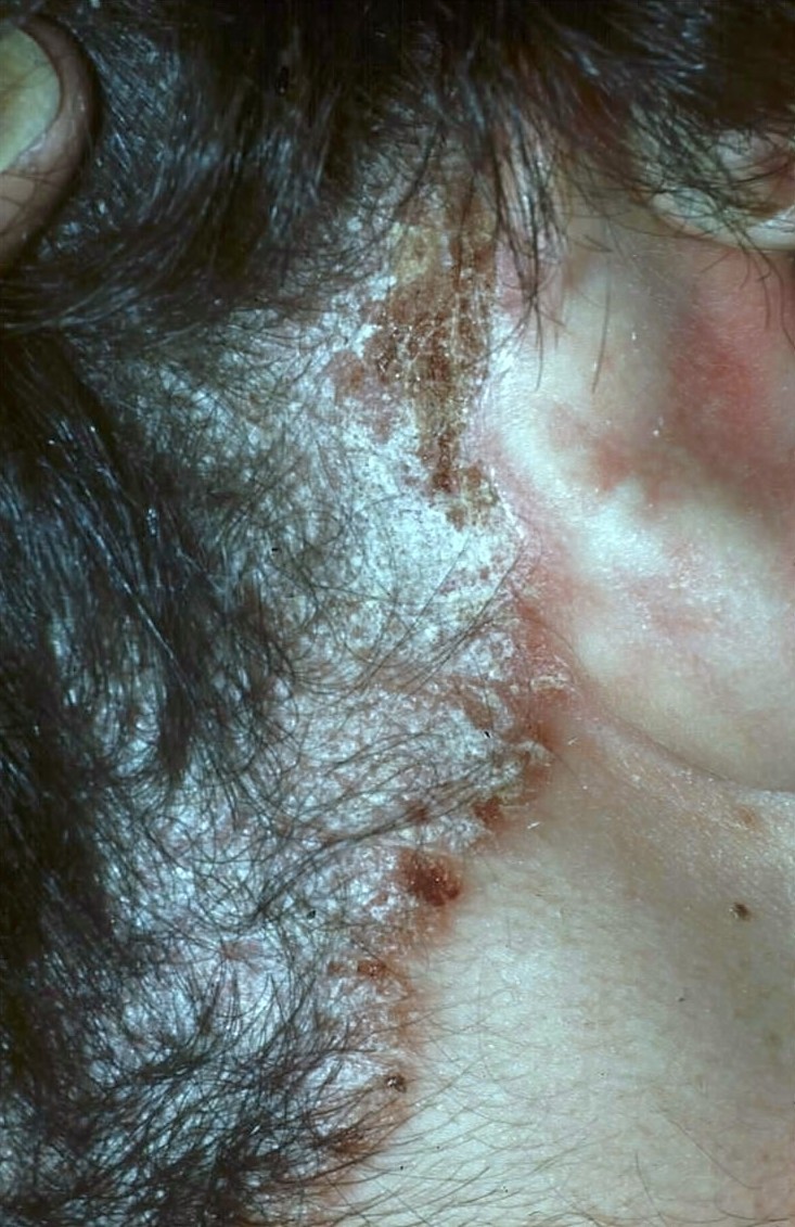 Scalp Psoriasis Including Neck