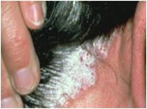Scalp Psoriasis On Neck Behind Ear