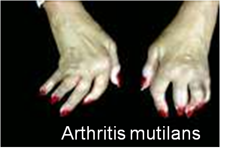 Arthritis Mutilans 1