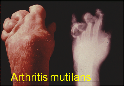Arthritis Mutilans