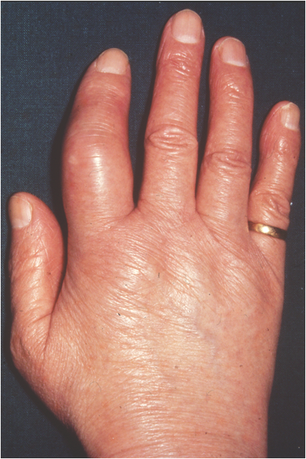 Dactylitis (1)