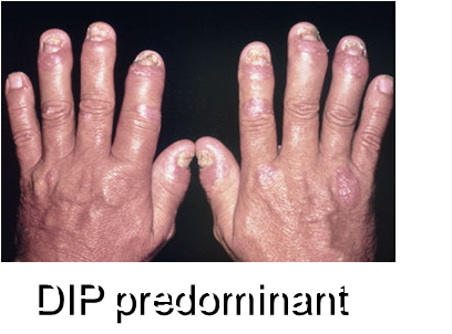 DIP Predominant