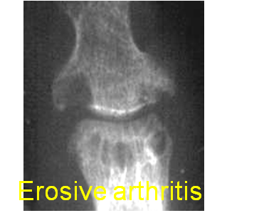 Erosive Joint