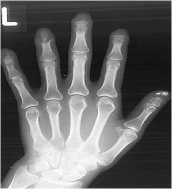 Osteolysis Hand