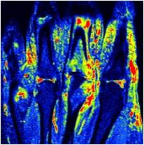 Psoriatic Arthritis – Extracapsular MRI