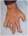 Psoriatic Arthritis Hands