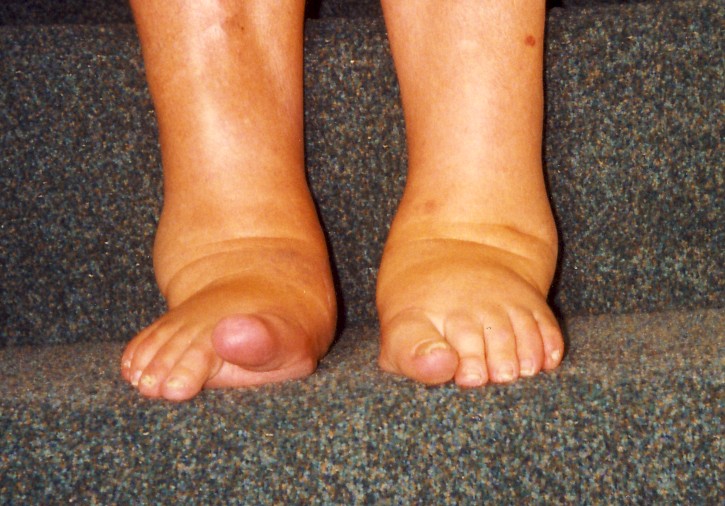 Psoriatic Arthritis Feet And Ankles Front View