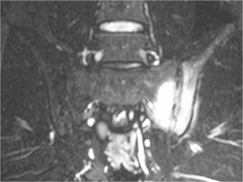 Sacroiliitis