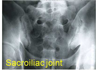 Sacroilliac