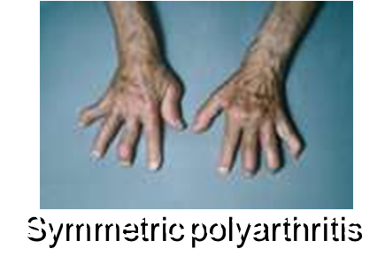 Symmetric Polyarthritis