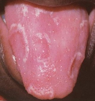Geographic Tongue 001